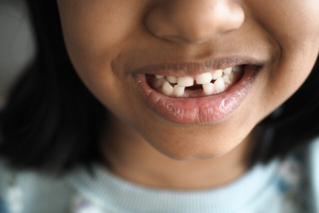 detail shot of child with missing teeth showing war's impact on oral health