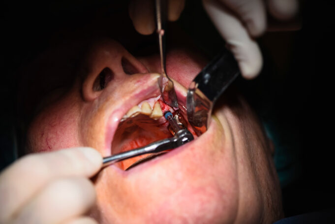 Saving Smiles and Wallets: Periodontal Treatment Often Wins Over Implants